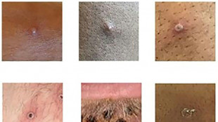 Variole du singe: l'OMS appelle &agrave; l'action "urgente" en Europe face &agrave; la flamb&eacute;e des cas