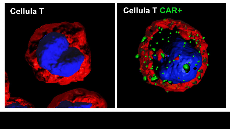 Linfomi, il 70-75% dei pazienti pu&ograve; guarire o vivere a lungo